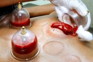 Wet-cupping_Blood